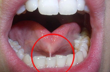 舌小帯強直症