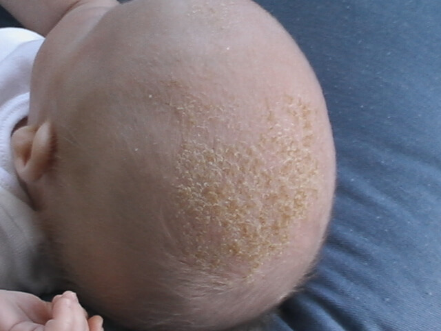 乳児脂漏性湿疹